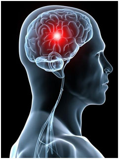 Infarctul Cerebral - Simptome, Consecințe și Tratament